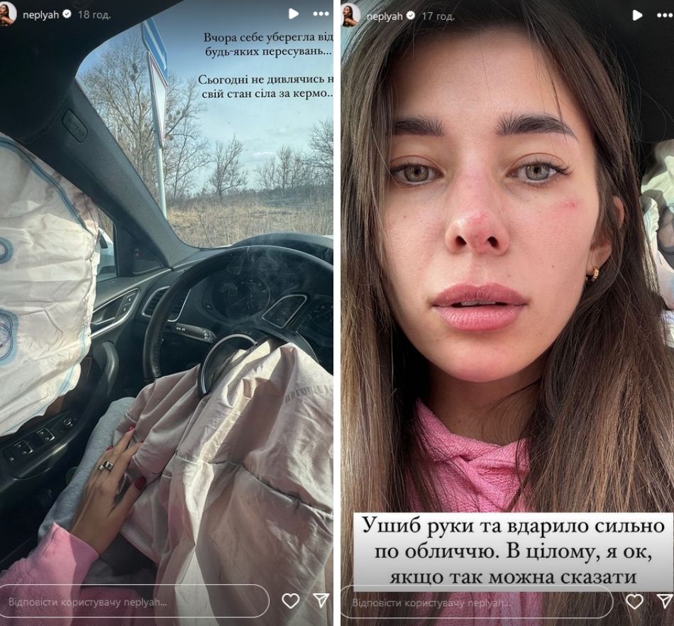 Вдарило сильно по обличчю: “Міс Україна Всесвіт” Анна Неплях потрапила у серйозну ДТП